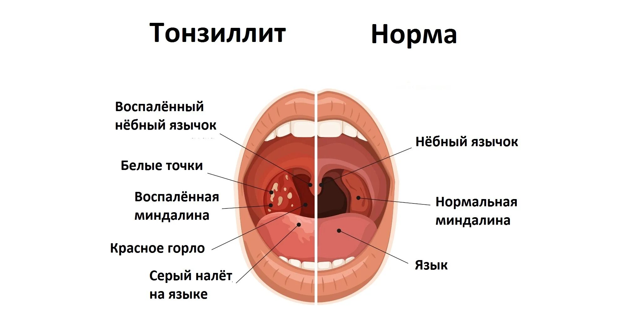 Ожог язычка в горле фото Симптомы тонзиллита / Статьи / Семейная клиника А-Медия