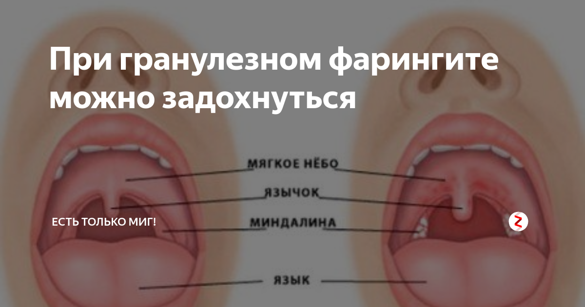 Ожог язычка в горле фото Горло красное кашель лечить ребенка