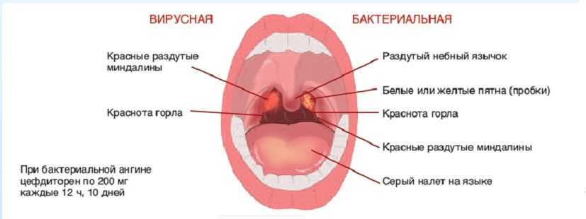 Ожог язычка в горле фото Ongoing throat pain
