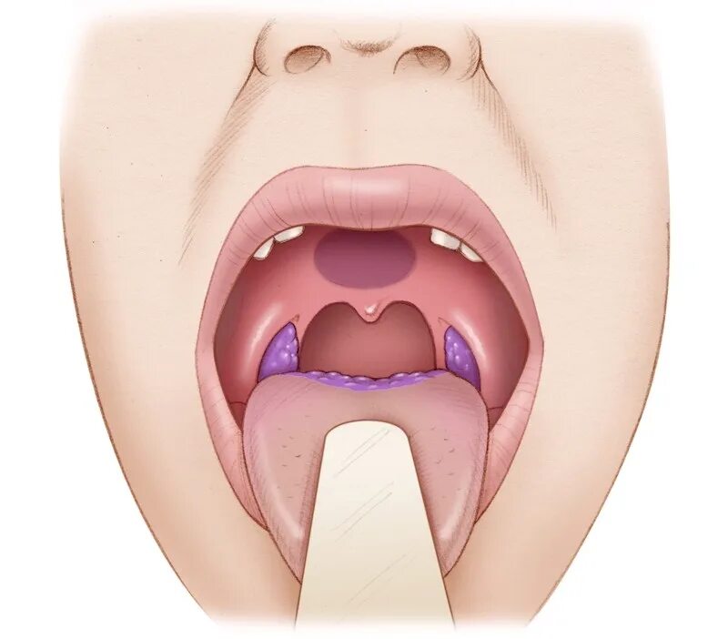 Ожог язычка в горле фото Oropharyngeal Cancer Otolaryngology - Head & Neck Surgery Stanford Medicine