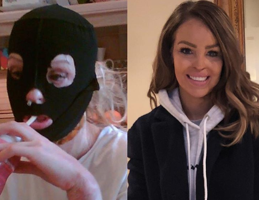 Ожоги до и после фото Acid attack survivor shares powerful #10YearChallenge post