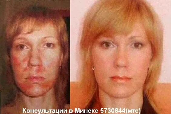 Ожоги до и после фото Ожог лица 2 степени - Olphoto.ru