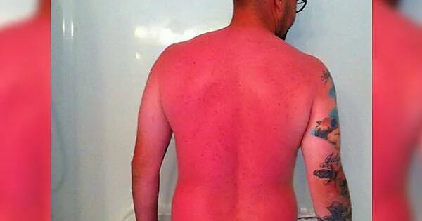 Ожоги до и после фото Europe at the moment - Album on Imgur