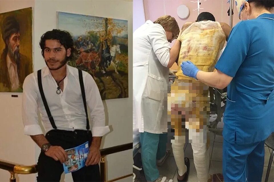 Ожоги до и после фото Он просто горел заживо". Пермяки просят помочь студенту из Ирака, который получи