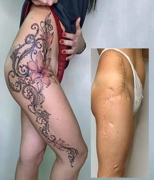 Ожоги до и после фото Стали шрамами на теле песня