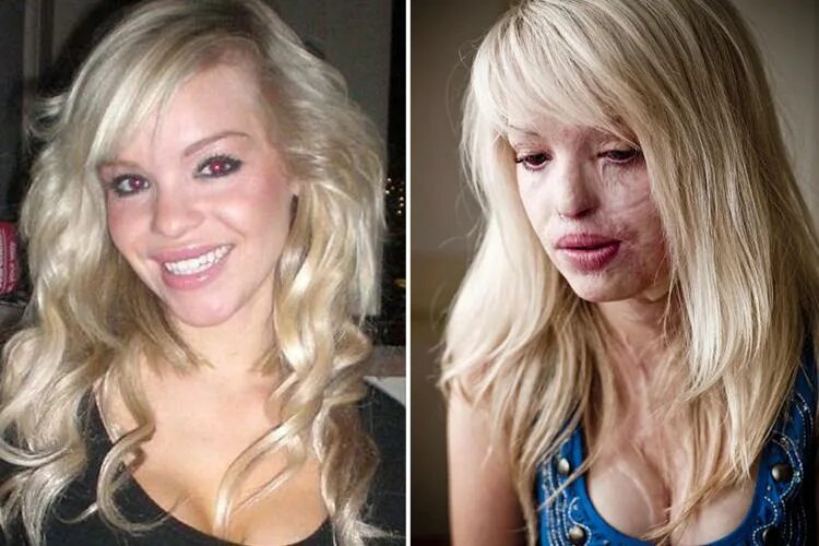 Ожоги до и после фото Acid attack victim Katie Piper describes gruelling daily struggle after undergoi