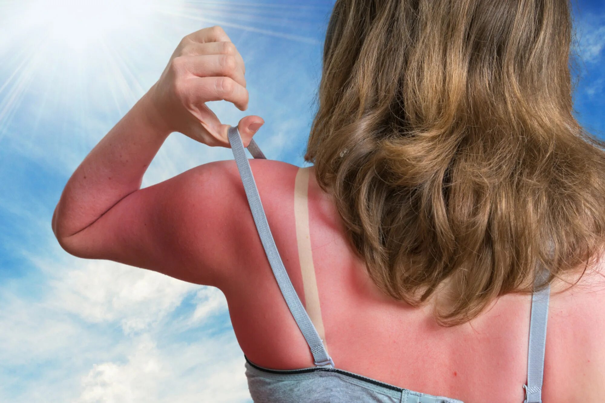 Ожоги после солнца фото How sunburn harms our skin, often years later, and how to avoid it: apply sunscr