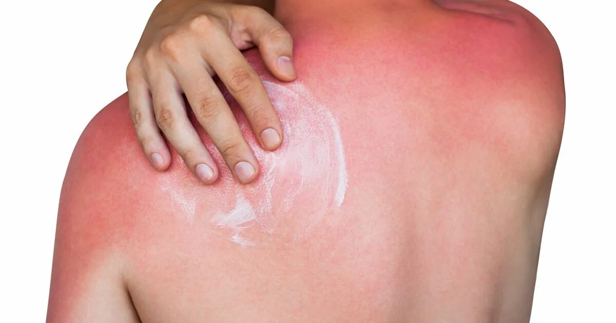 Ожоги после солнца фото How to get rid of sunburn quickly - top tips and tricks - Cambridgeshire Live