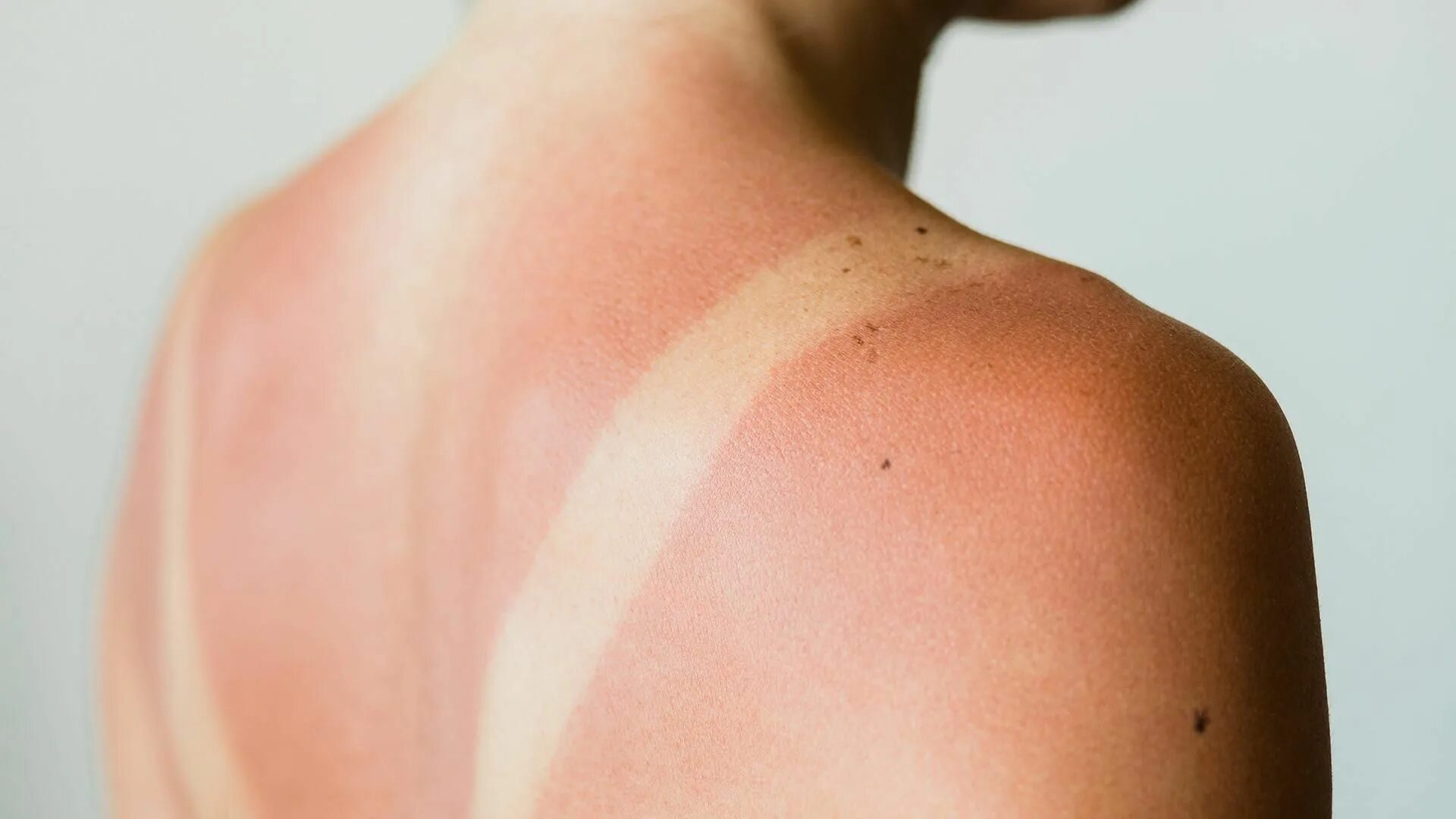 Ожоги после солнца фото How To Treat Sunburn, According To Rach's Dermatologist How to treat sunburn, Su