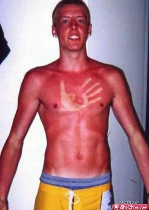 Ожоги после солнца фото Pale Is The New Tan: Sun burns are bad, mmmKay? Sunburn, Bad sunburn, Health and