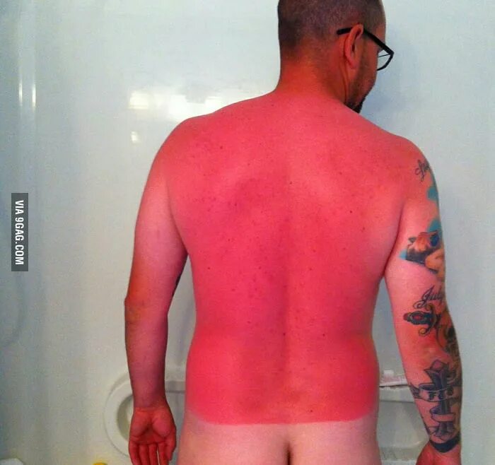 Ожоги после солнца фото Wear sunscreen, kids. - 9GAG