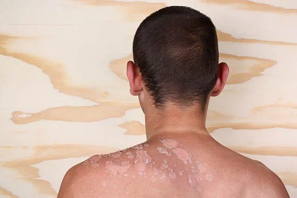 Ожоги после солнца фото Best Sun Damaged Skin Stock Photos, Pictures & Royalty-Free Images - iStock