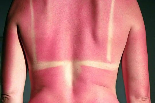 Ожоги после солнца фото Sunburn Зображення - огляд 1,337,323 Стокові фото, векторні зображення й відео A