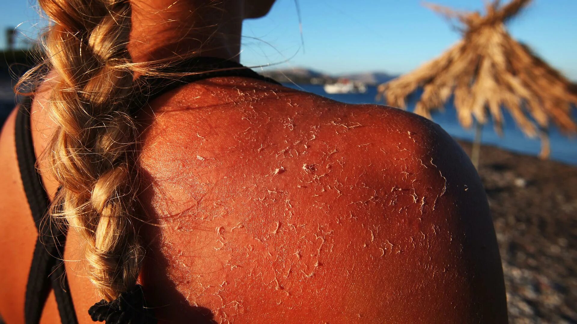 Ожоги после солнца фото How many sunburns does it take to get skin cancer?