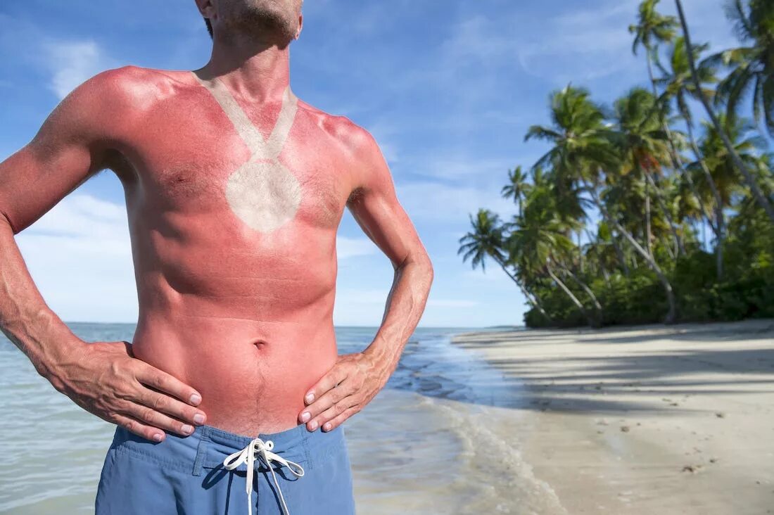 Ожоги после солнца фото How Often to Put on Sunscreen, According to a Dermatologist - Business Insider