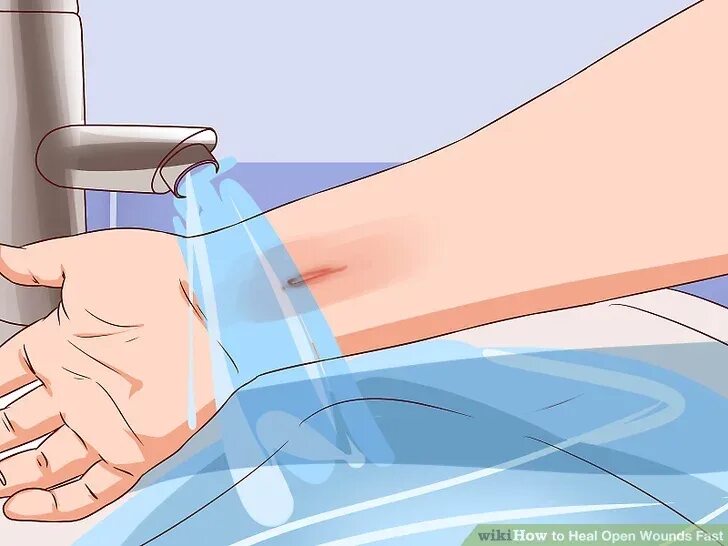 Ожоги водой фото 3 Ways to Heal Open Wounds Fast - wikiHow