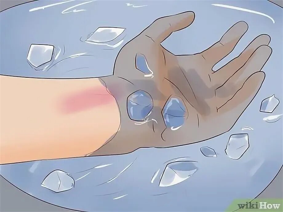 Ожоги водой фото Een kleine brandwond behandelen - wikiHow