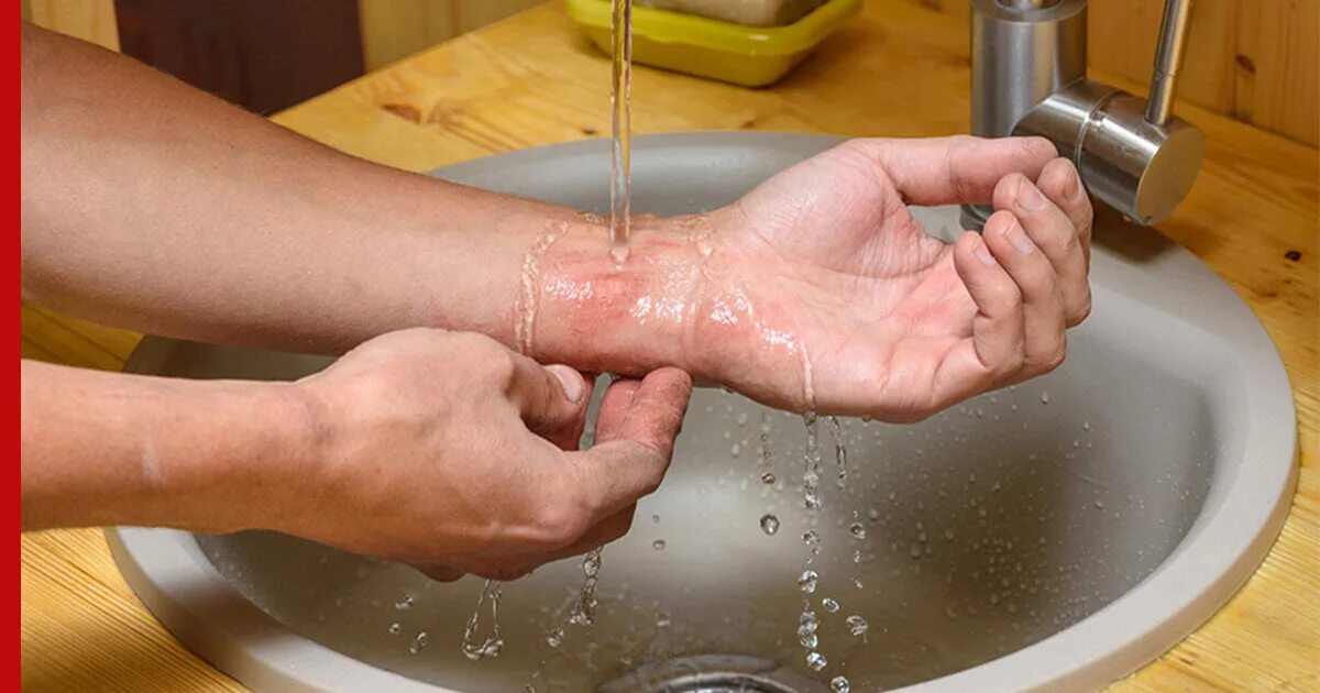 Ожоги водой фото Названы две распространенные ошибки при оказании первой помощи после ожога