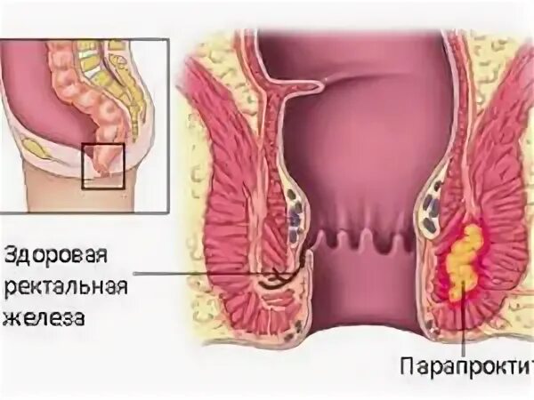 Парапроктит фото снаружи Народные средства