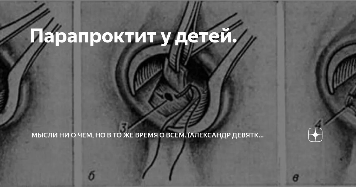 Парапроктит симптомы у женщин фото что такое Парапроктит у детей. Мысли ни о чем, но в то же время о всем. (Александр Девятки