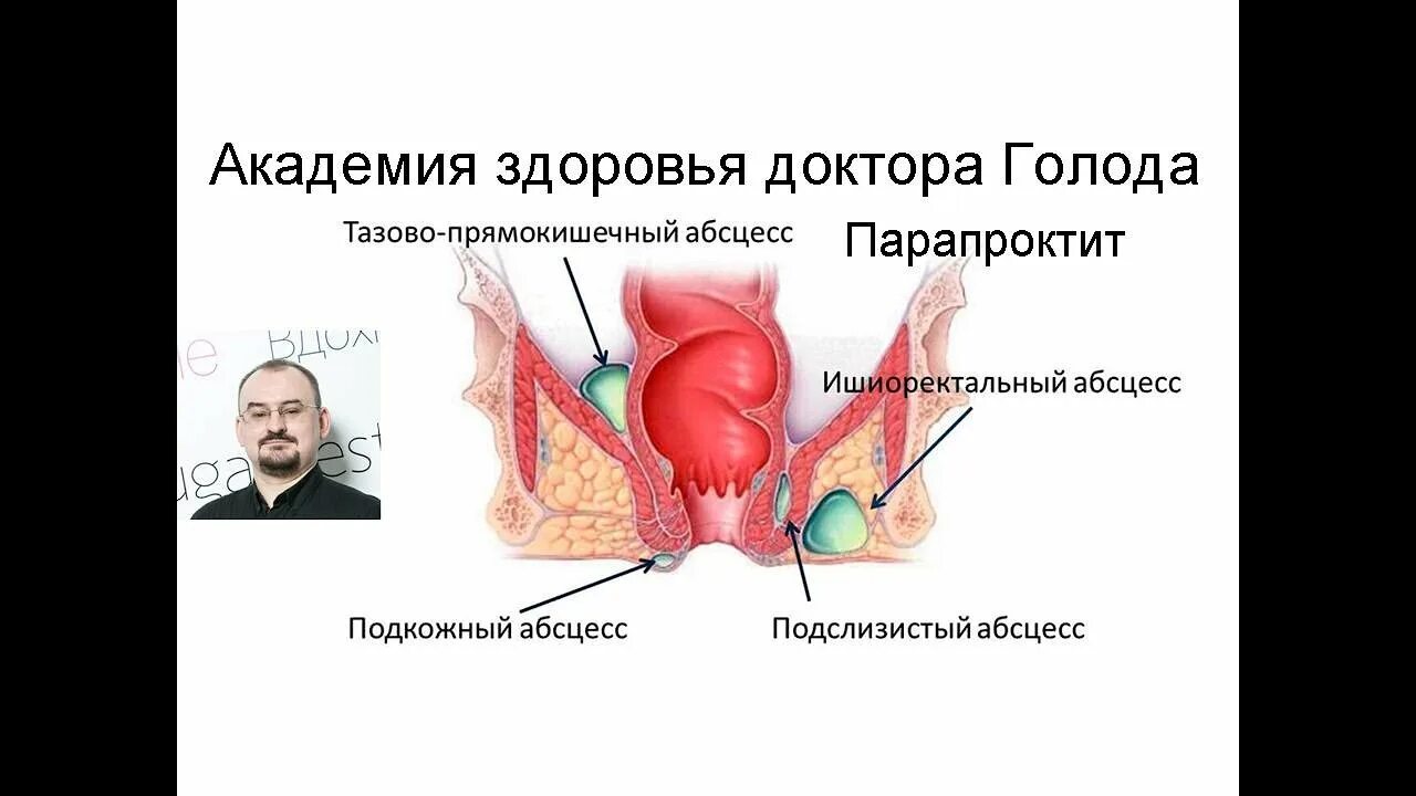 Парапроктит симптомы у женщин фото что такое Парапроктит и его лечение. - YouTube