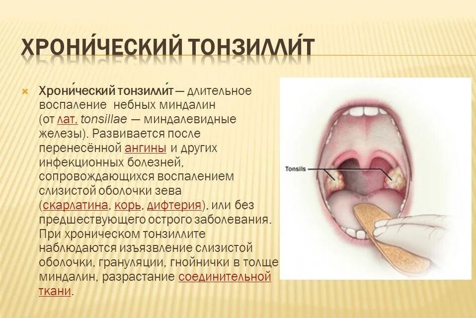 Паратонзиллит фото горла и описание Вечно больное горло и ангины: что такое хронический тонзиллит и удалять ли минда