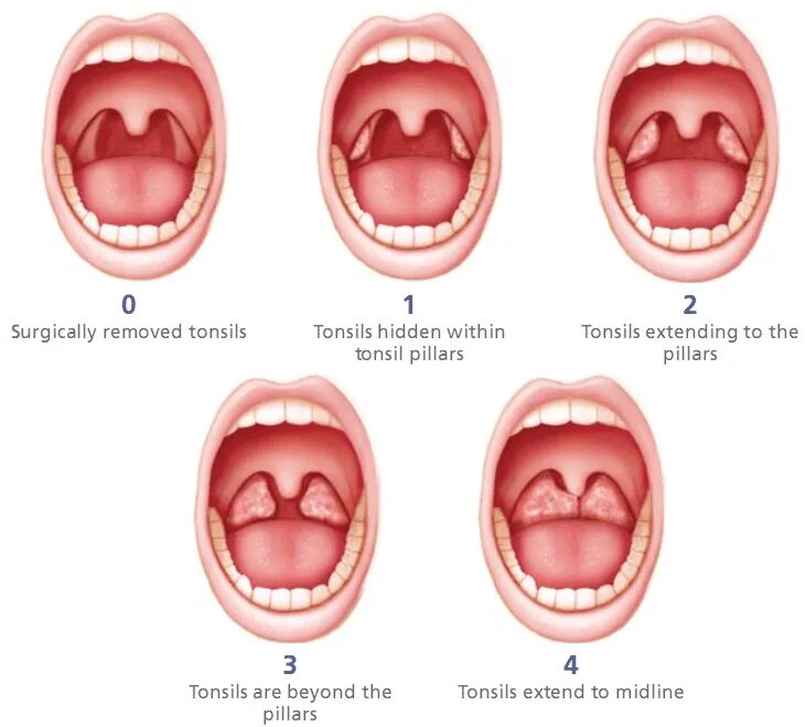Паратонзиллит фото горла и описание Pin on Adult Health