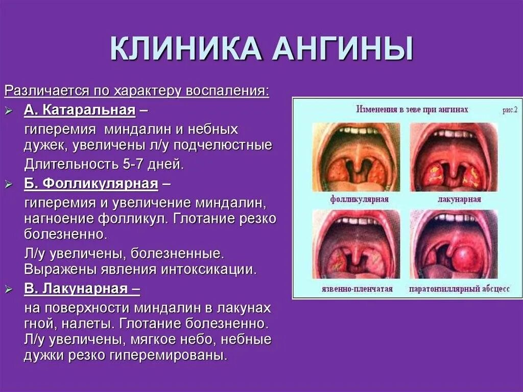 Паратонзиллит фото горла и описание Чем лечить горло и температуру у взрослого: найдено 88 картинок