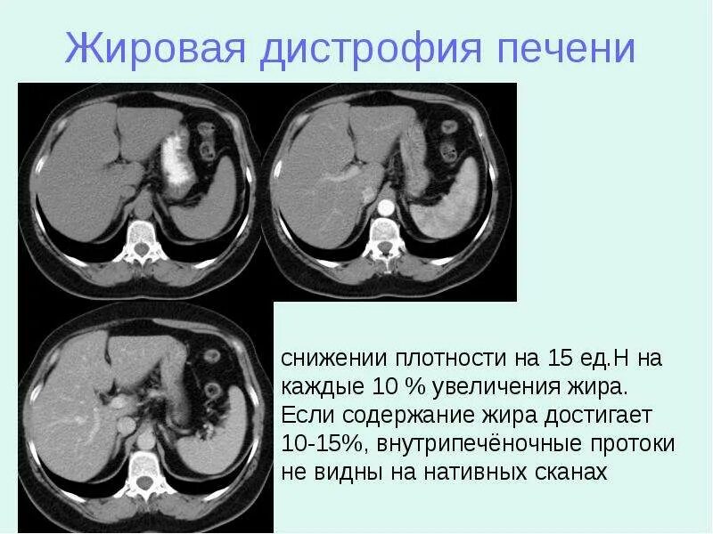 Паренхимы печени фото Плотность печени снижена что это значит