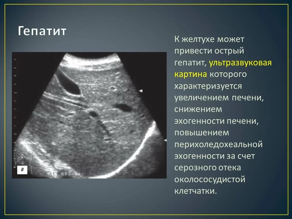 Паренхимы печени фото Эхогенность печени повышена: что это такое, и какой болезни это проявление?