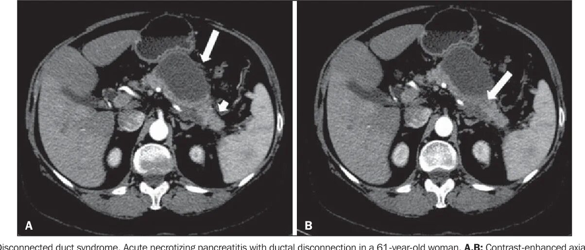 Паренхимы печени фото Figure 5 from Walled-off pancreatic necrosis and other current concepts in the r