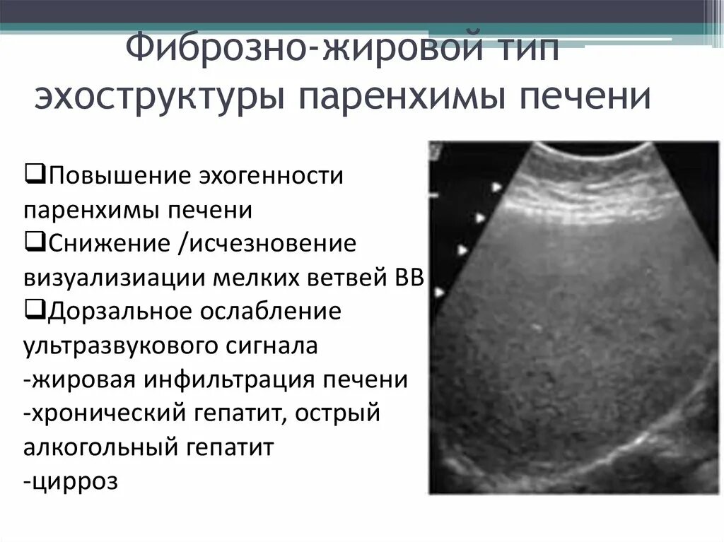 Паренхимы печени фото Структура поджелудочной железы неоднородная повышенной эхогенности - найдено 82 
