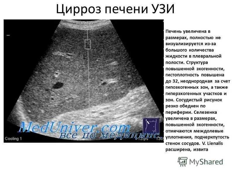 Паренхимы печени фото Структура поджелудочной железы неоднородная повышенной эхогенности - найдено 82 