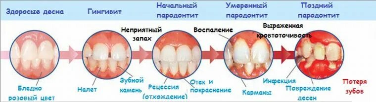 Пародонтит симптомы фото Пародонтология - atlantida74.ru
