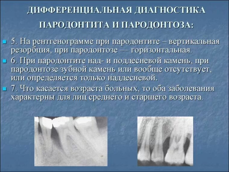 Пародонтит симптомы фото Diagnosis of periodontal disease: a modern approach and methods