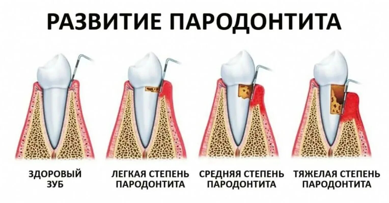 Пародонтит симптомы фото Степень пародонтита - Cтоматология Май