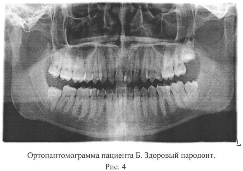 Пародонтит симптомы фото СПОСОБ ОЦЕНКИ СТЕПЕНИ ТЯЖЕСТИ ЗАБОЛЕВАНИЯ ПАРОДОНТА. Российский патент 2015 года