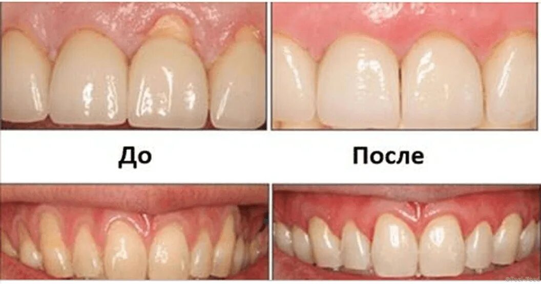 Пародонтит симптомы фото и лечение Пародонтология Лечения заболеваний дёсен аппаратом Vector Плазмолифтинг