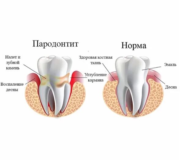 Пародонтит зуба фото Кто виноват, если во рту нет зубов и плохо пахнет