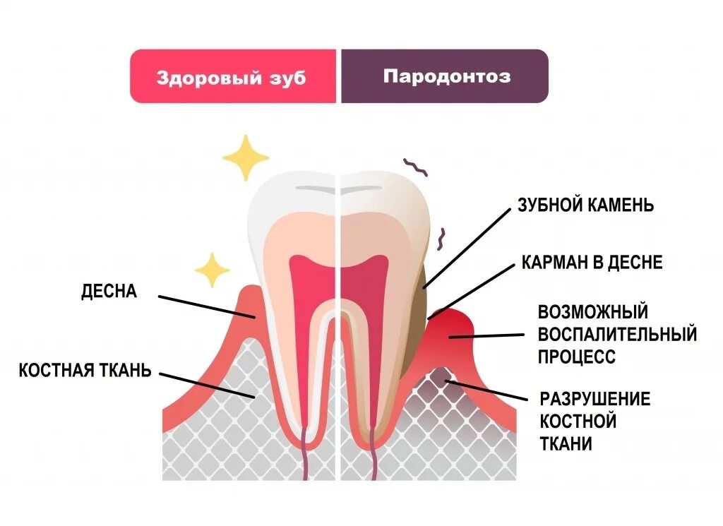 Пародонтоз фото стадий Пародонтоз - системное поражение околозубной ткани (пародонта) первичного дистро