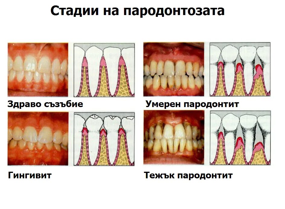 Пародонтоз фото стадий Пародонтоза Новини Dental.bg