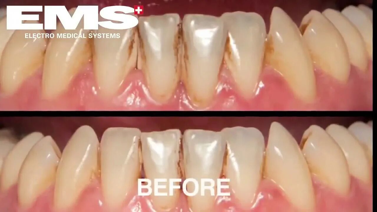 Пародонтоз фото стадий Airflow Dental Cleaning - YouTube