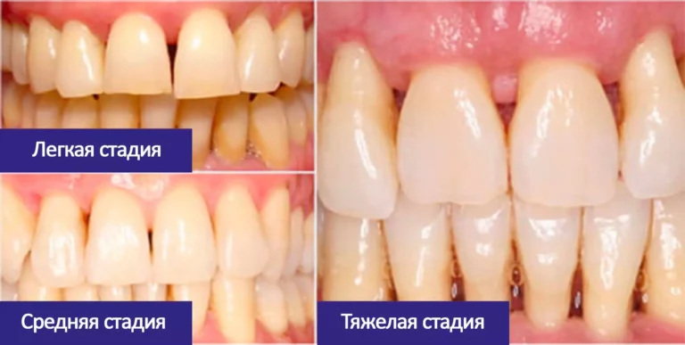 Пародонтоз фото стадий Лечение пародонтоза в Томске ✔ Цены ✔ Фото ✔ Отзывы