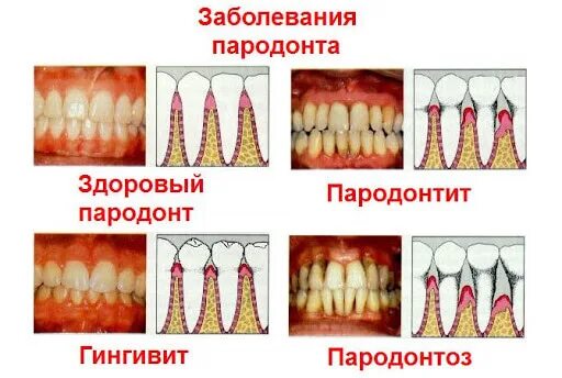 Пародонтоз фото стадий Имплантация зубов при пародонтозе и пародонтите в Москве под ключ
