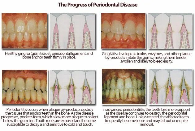 Пародонтоз фото стадий 4 stages of periodontal disease: Gingivitis Mild periodontitis Moderate periodon