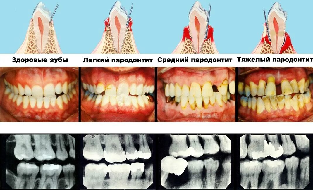 Пародонтоз фото стадий Имплантация при пародонтозе и пародонтите - Хирургическая стоматология
