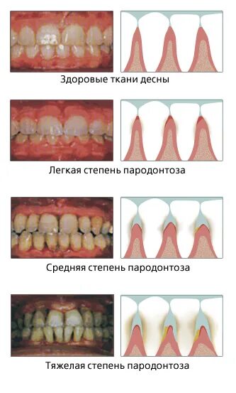 Пародонтоз симптомы фото Лечение пародонтоза