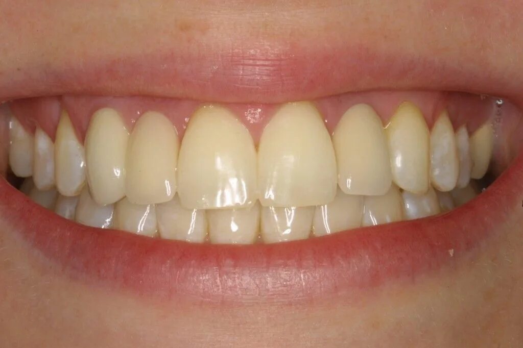 Пародонтоз зубов фото Comfort Care Dental Group
