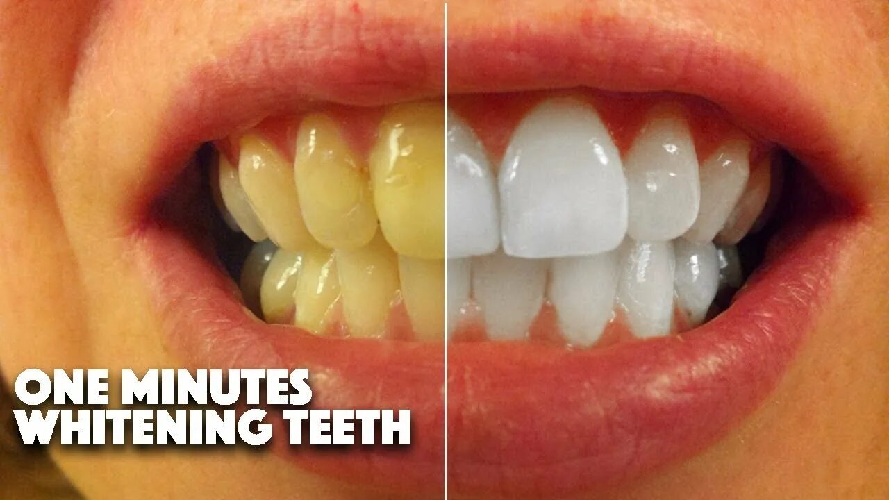 Пародонтоз зубов фото до и после How To Whitening Teeth Photoshop Tutorials One Minutes - YouTube