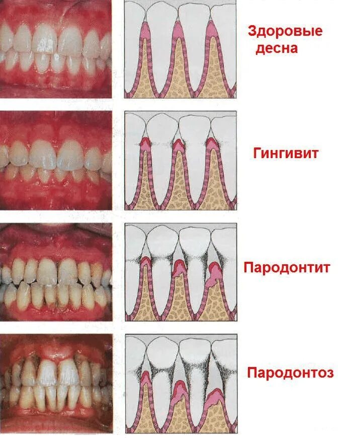 Пародонтоз зубов фото до и после Диагностика и эффективное лечение десен зубов в Новосибирске